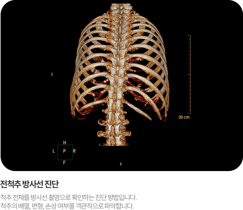 전척추방사선진단